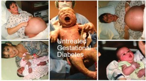 Untreated Gestational Diabetes
